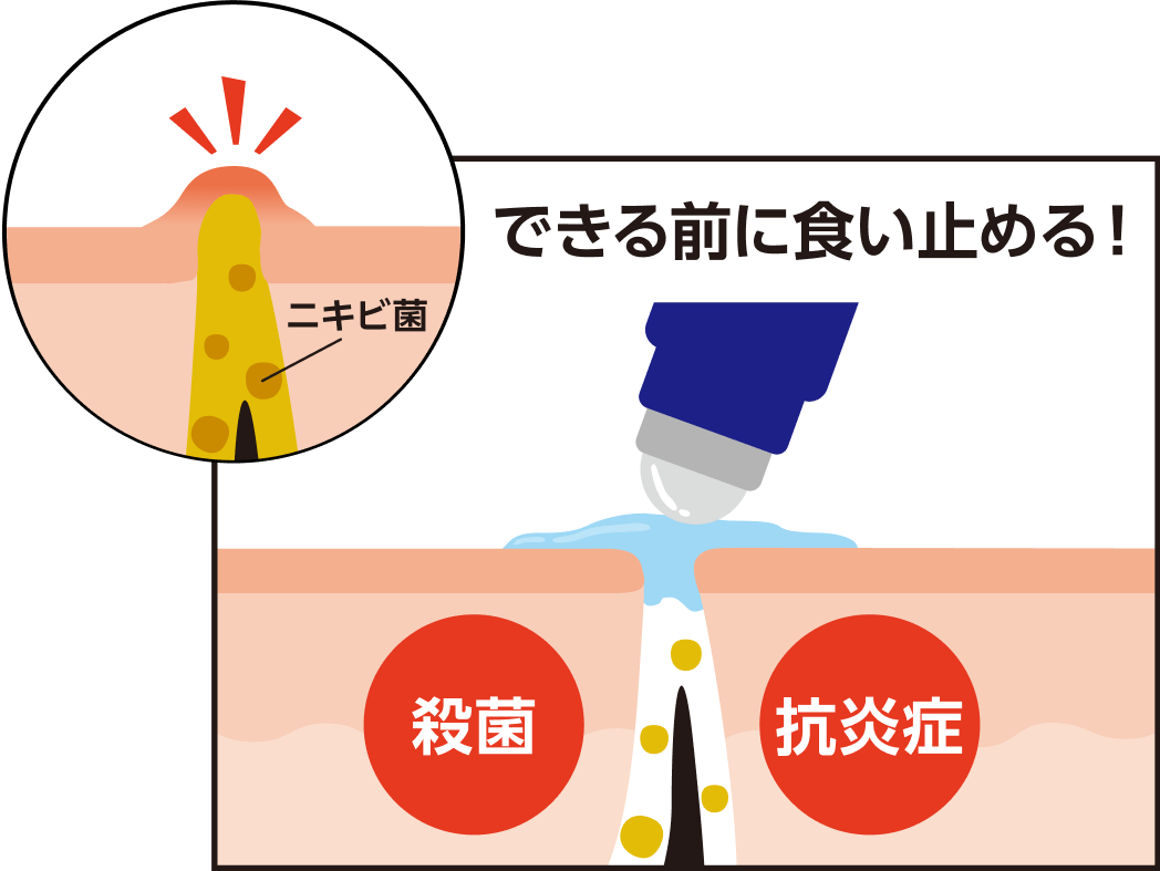 できる前に食い止める! 殺菌 抗炎症