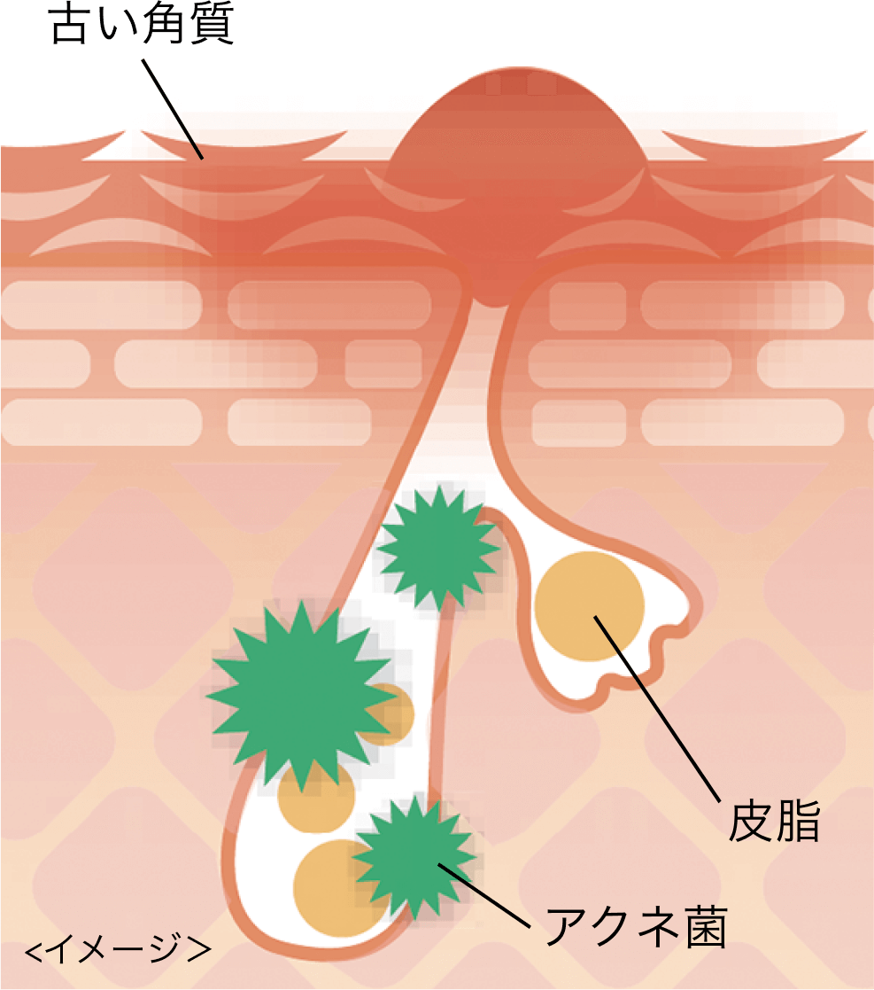 イメージ 古い角質 皮脂 アクネ菌