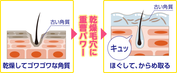 乾燥してゴワゴワな角質 乾燥毛穴に重曹パワー ほぐして、からめ取る
